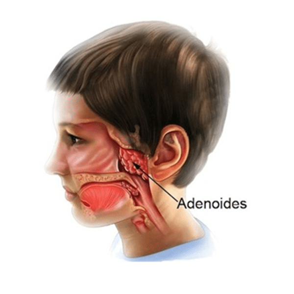 Adenoide (Carne Esponjosa)